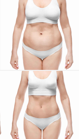 Tummy Tuck 