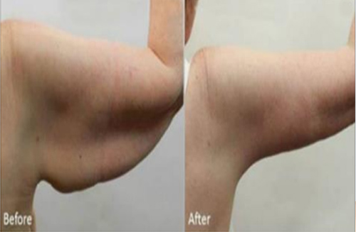 Body Wrap Treatment
