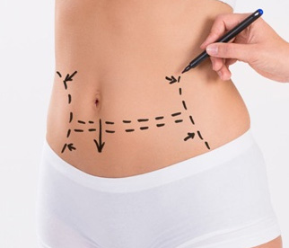 Tummy Tuck